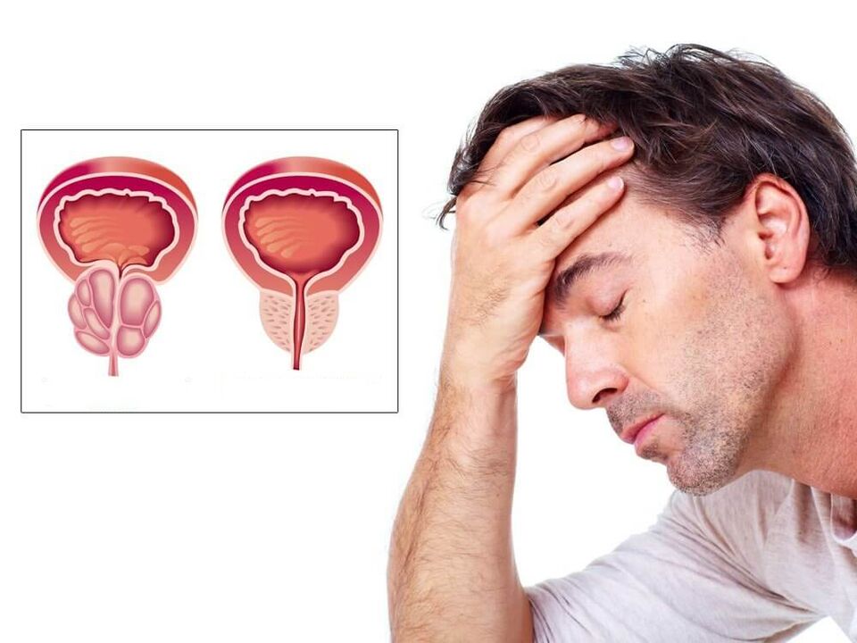 prostatitisaren sintomak gizonezkoetan