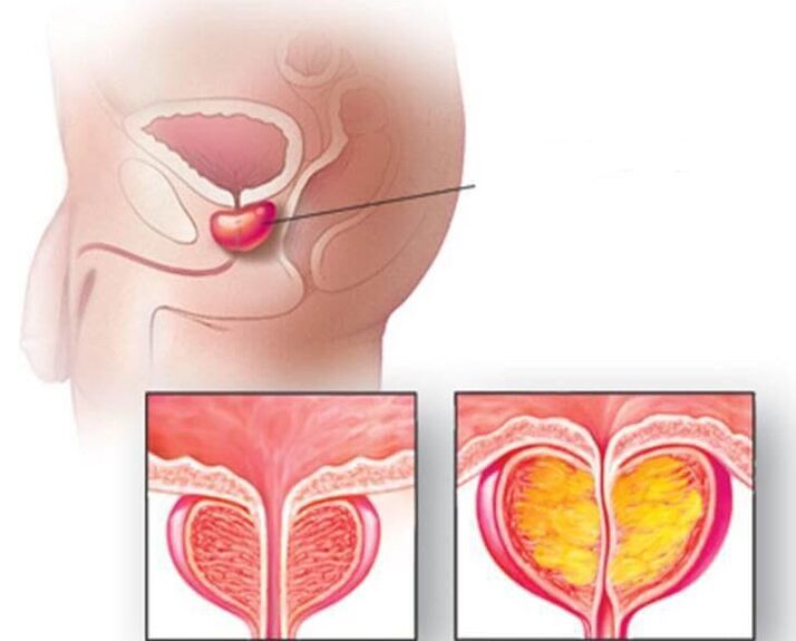 Prostatako guruinaren kokapena, prostatako normala eta prostatitis kronikoan handitua