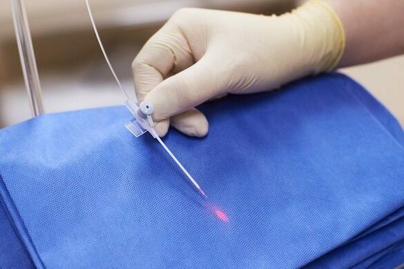 Zenbait kasutan, laser terapia erabiltzen da prostatitis kronikorako