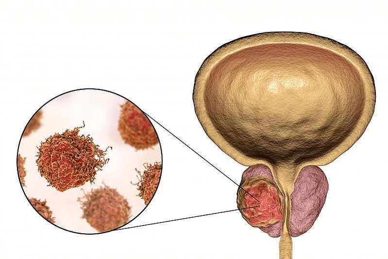 nolakoa da prostatako kaltea