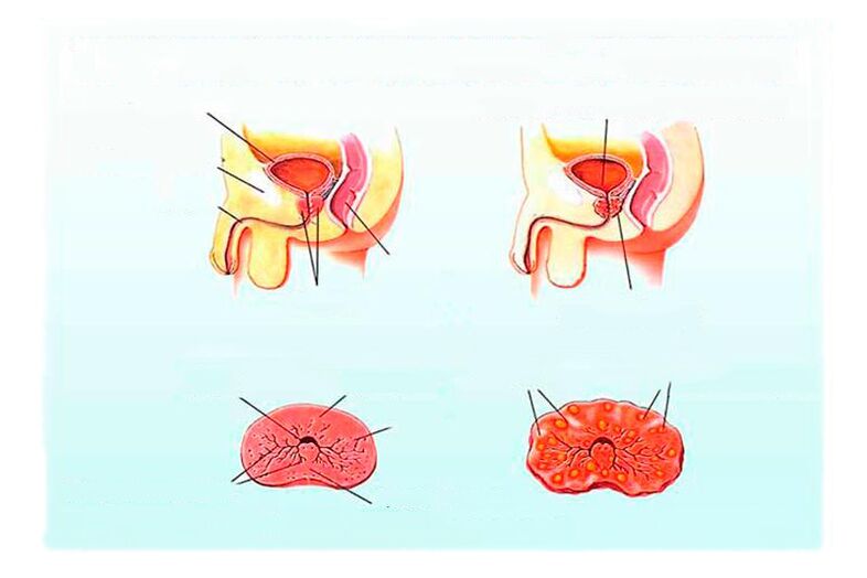 Prostatitis kronikoaren seinaleak