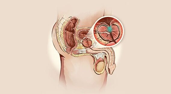 Prostata