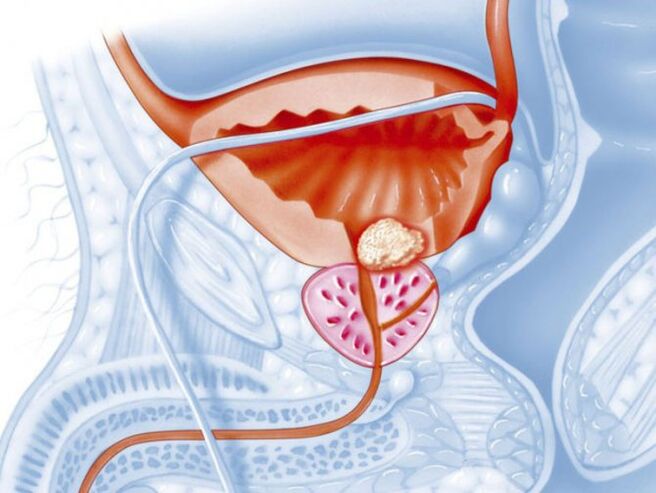 Prostatitis bakterianoa