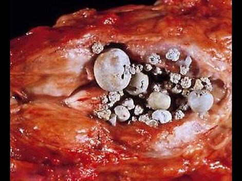 Prostatitis kalkulua