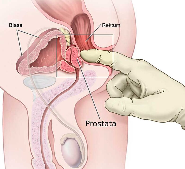 prostatako masajea prostatitisa egiteko