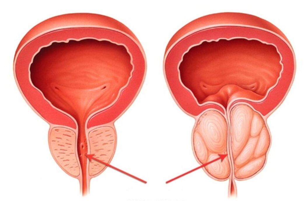 prostatitisarekin prostata osasuntsu eta hanturatuta